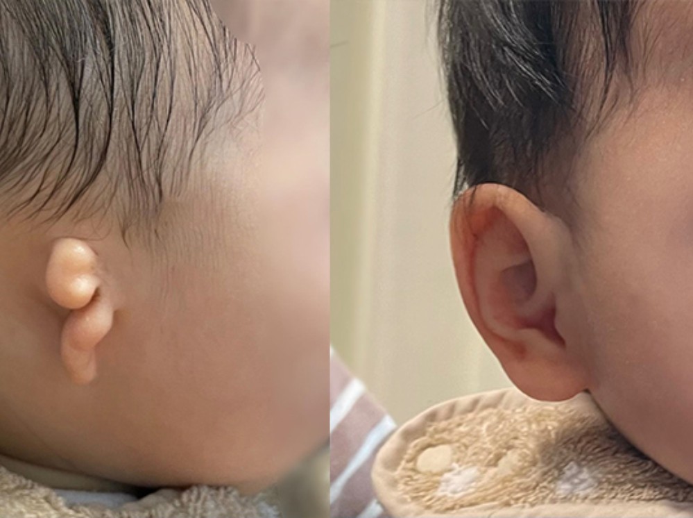 儿童小耳畸形定制义耳（婴幼儿专用）